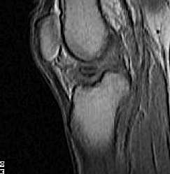 ACL Bony Avulsion Sagittal MRI